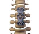 Anterior Cervical Discectomy and Fusion