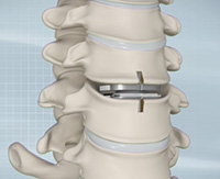 Cervical Disc Replacement