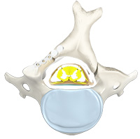 Cervical Laminoplasty