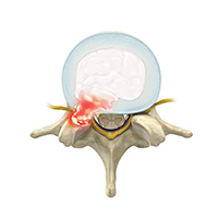 Herniated disc