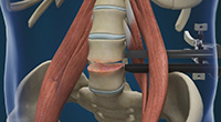 Lumbar Discectomy