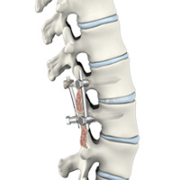 Transforaminal Lumbar Interbody Fusion