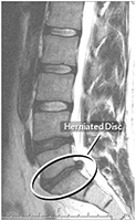 Herniated Disc Treated